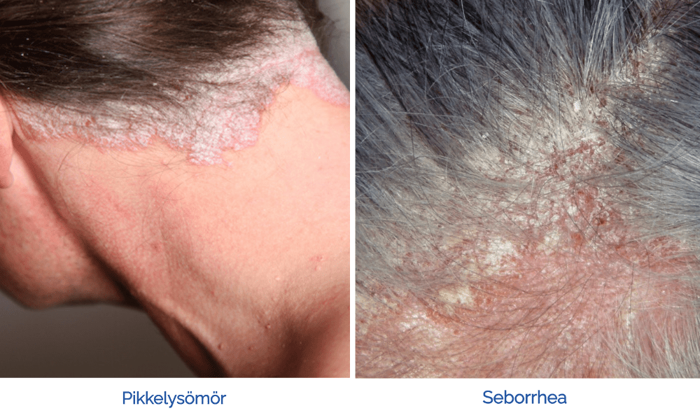 Seborrhoea How To Recognize It And What Is The Solution Oxygeni Hair