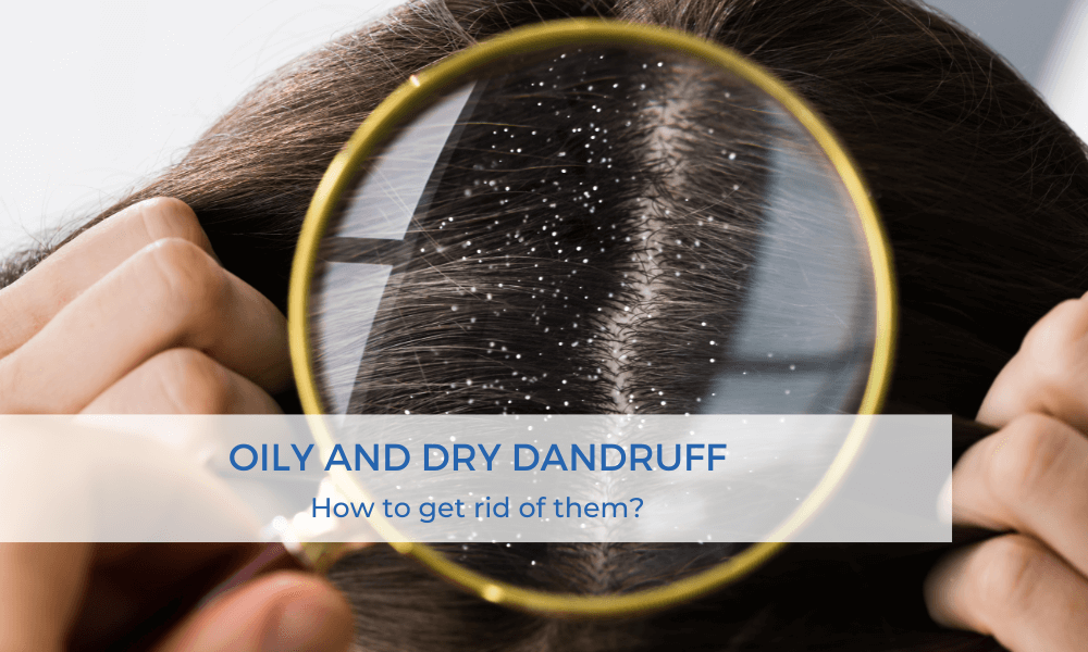 oily and dry dandruff