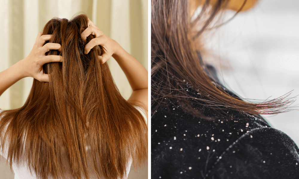 oily and dry dandruff