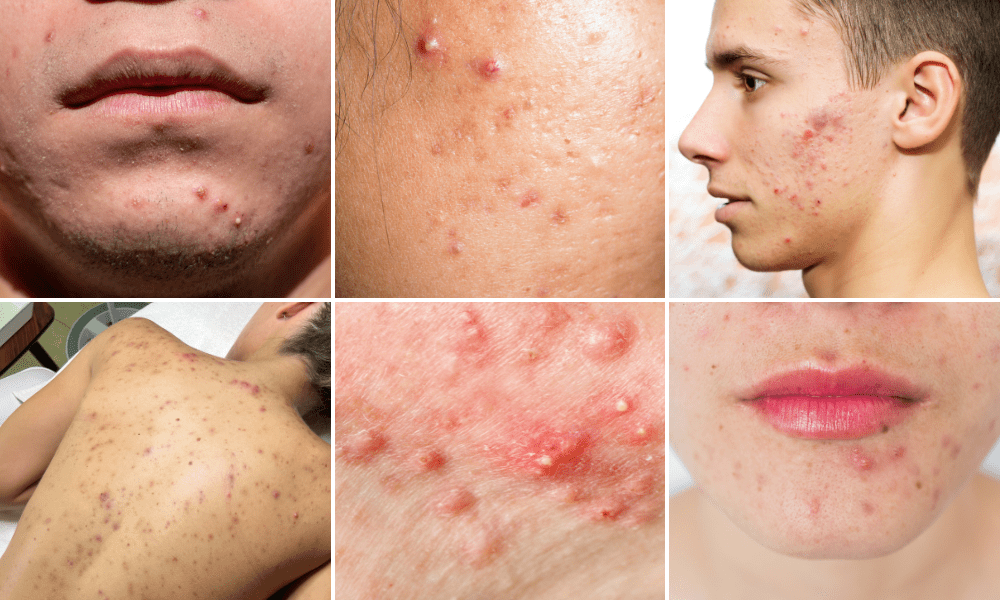 acne most common skin conditions