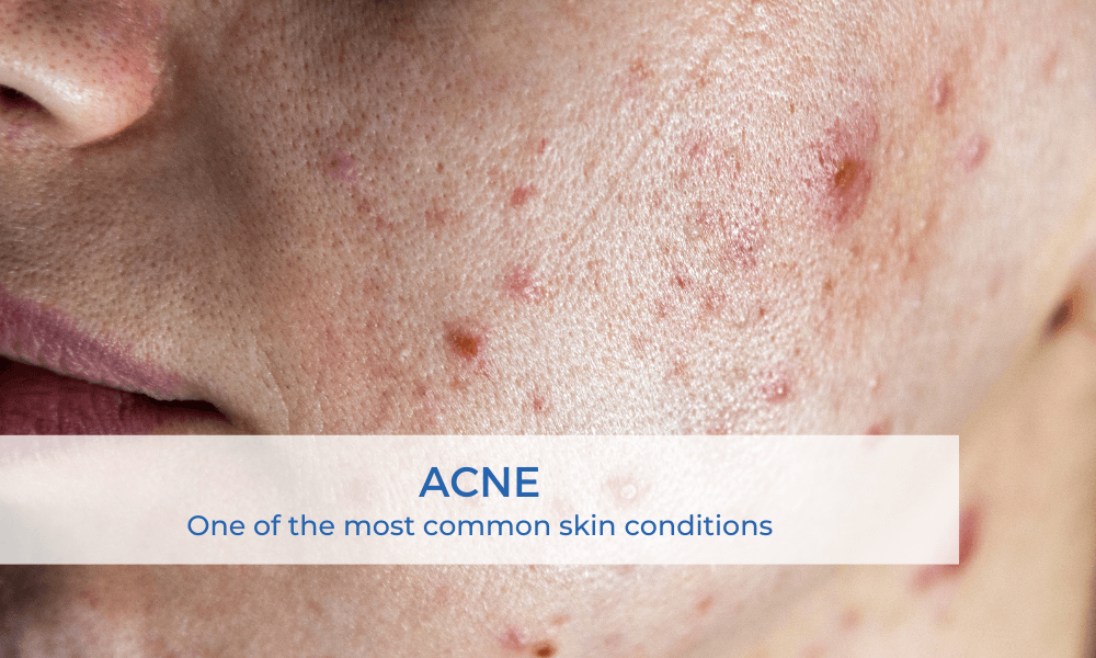 acne most common skin conditions