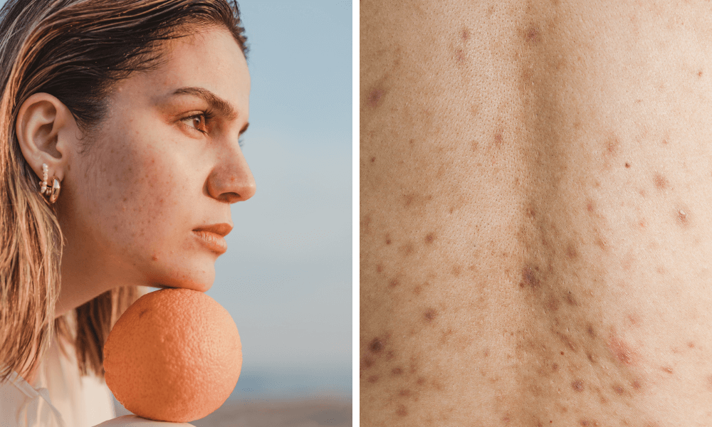 acne most common skin conditions