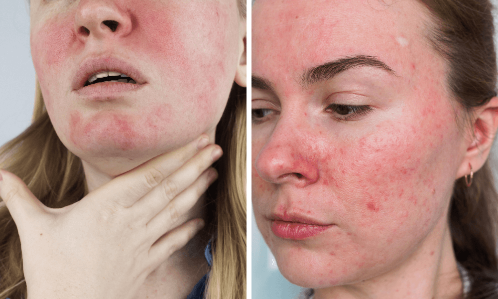 rosacea treatment