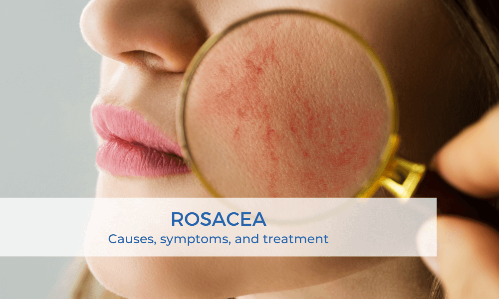 rosacea treatment